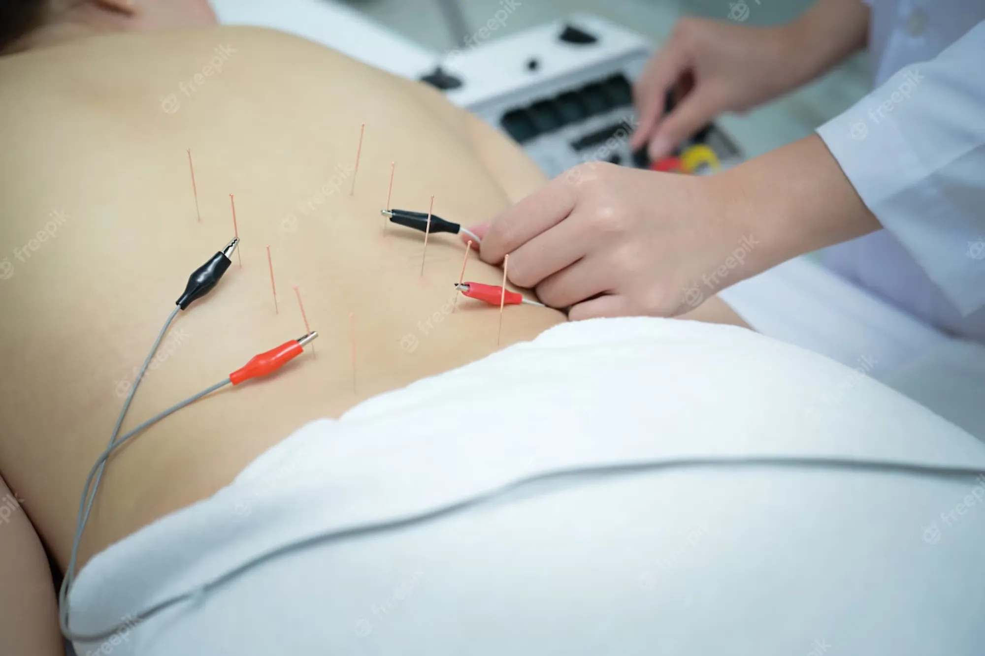 Electroacupuncture